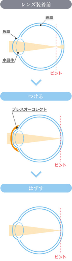 オルソケラトロジーの仕組み