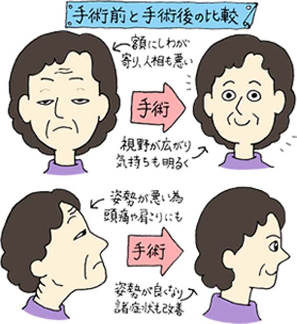 まぶた治療　手術前と手術後の比較