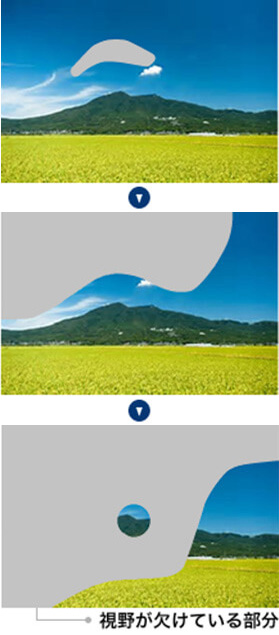 緑内障図