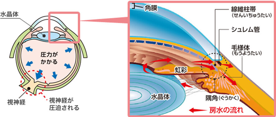 眼圧が挙がる原因