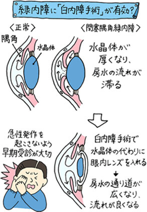 緑内障には「白内障手術」が有効？